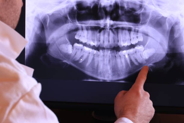 Best Emergency Wisdom Teeth Removal in Westport, NC